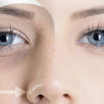 treatment dark circles under eyes filler injection